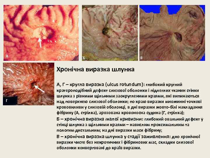 А Б В Хронічна виразка шлунка А, Г – кругла виразка (ulcus rotundum): глибокий