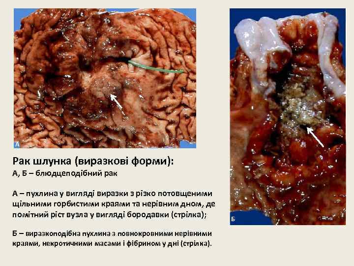 А Рак шлунка (виразкові форми): А, Б – блюдцеподібний рак А – пухлина у