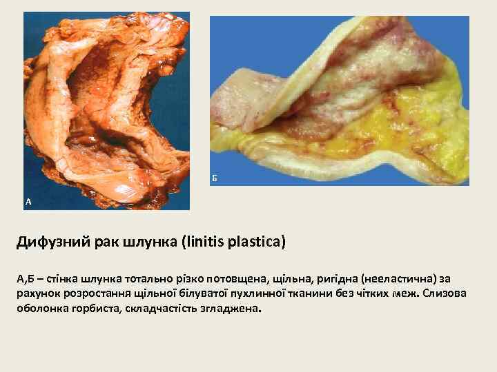 Б А Дифузний рак шлунка (linitis plastiсa) А, Б – стінка шлунка тотально різко
