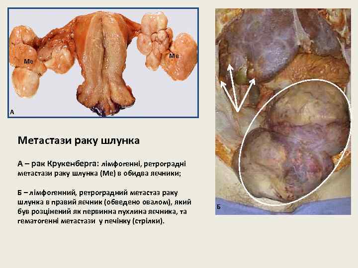 Ме Ме А Метастази раку шлунка А – рак Крукенберга: лімфогенні, ретроградні метастази раку