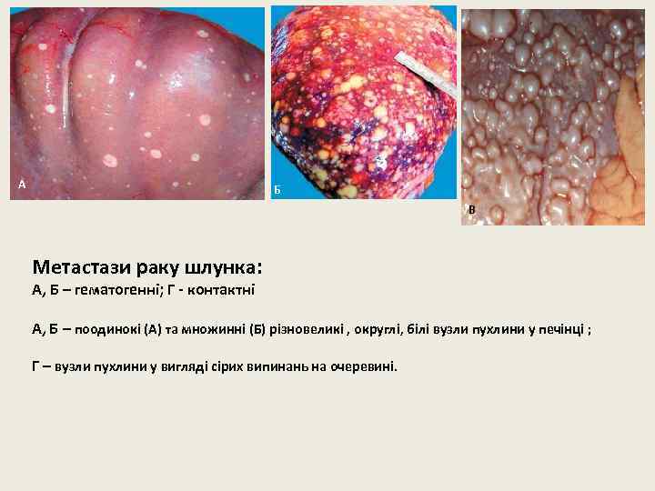 А Б В Метастази раку шлунка: А, Б – гематогенні; Г - контактні А,