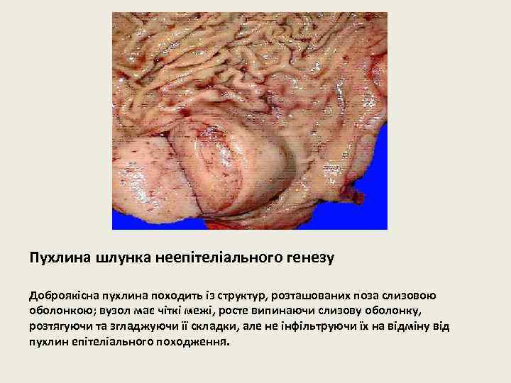 Пухлина шлунка неепітеліального генезу Доброякісна пухлина походить із структур, розташованих поза слизовою оболонкою; вузол