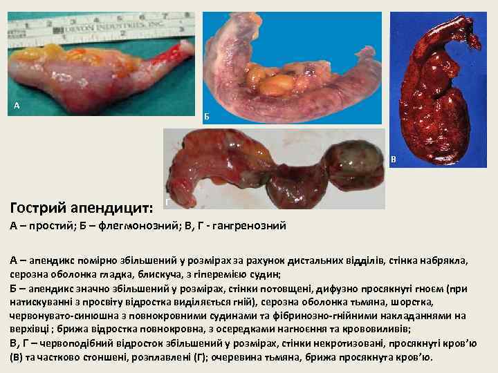 А Б В Гострий апендицит: Г А – простий; Б – флегмонозний; В, Г