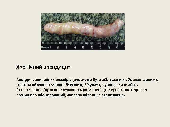 Хронічний апендицит Апендикс звичайних розмірів (але може бути збільшеним або зменшеним), серозна оболонка гладка,