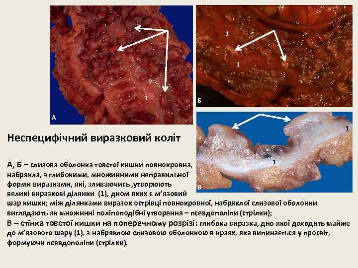 1 1 1 Б А 1 Неспецифічний виразковий коліт А, Б – слизова оболонка