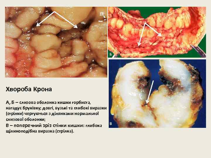 Б А Хвороба Крона А, Б – слизова оболонка кишки горбиста, нагадує бруківку; довгі,