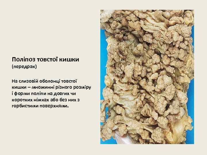 Поліпоз товстої кишки (передрак) На слизовій оболонці товстої кишки – множинні різного розміру і