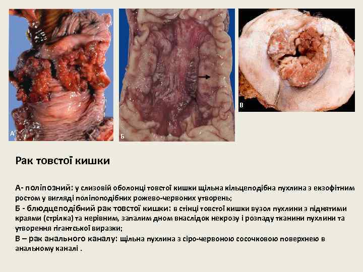 В А Б Рак товстої кишки А- поліпозний: у слизовій оболонці товстої кишки щільна