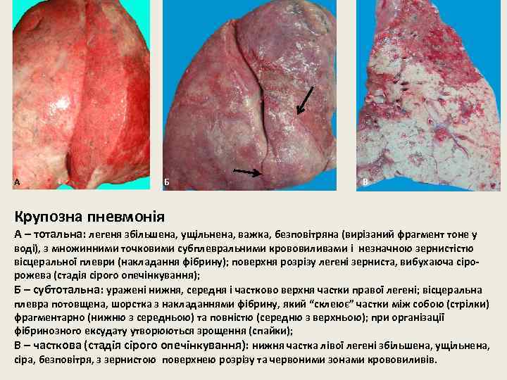 А Б В Крупозна пневмонія А – тотальна: легеня збільшена, ущільнена, важка, безповітряна (вирізаний