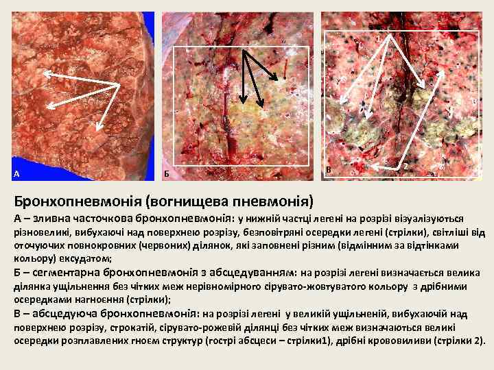 1 А Б В 2 Бронхопневмонія (вогнищева пневмонія) А – зливна часточкова бронхопневмонія: у