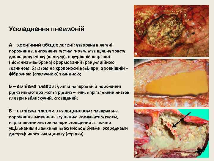 Ускладнення пневмоній А – хронічний абсцес легені: утворена в легені порожнина, виповнена густим гноєм,