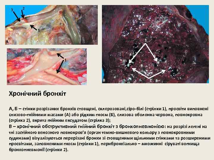 3 2 1 1 А 1 Б В 2 Хронічний бронхіт А, Б –