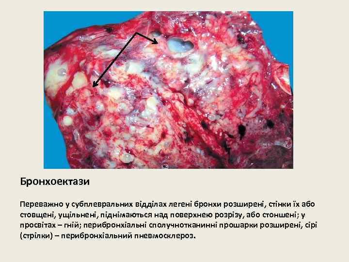 Бронхоектази Переважно у субплевральних відділах легені бронхи розширені, стінки їх або стовщені, ущільнені, піднімаються