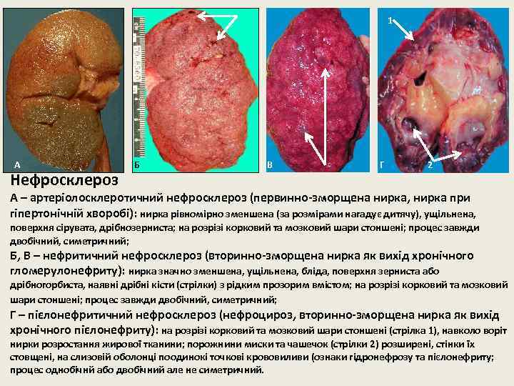 1 А Нефросклероз Б В Г 2 А – артеріолосклеротичний нефросклероз (первинно-зморщена нирка, нирка