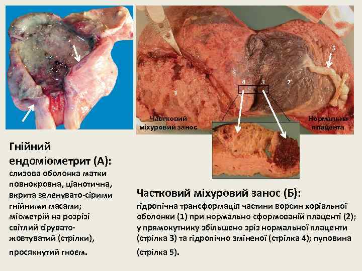5 4 3 2 1 Частковий міхуровий занос Нормальна плацента Гнійний ендоміометрит (А): слизова