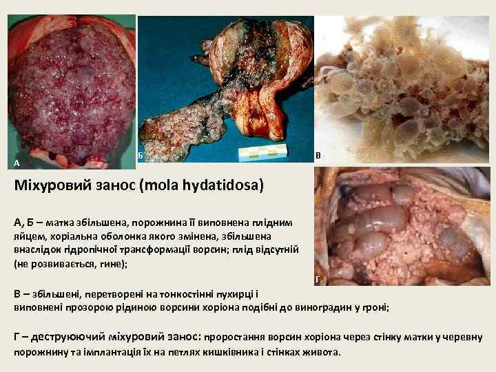 А Б В Міхуровий занос (mola hydatidosa) A, Б – матка збільшена, порожнина її