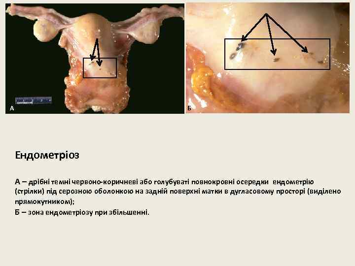 А Б Ендометріоз А – дрібні темні червоно-коричневі або голубуваті повнокровні осередки ендометрію (стрілки)