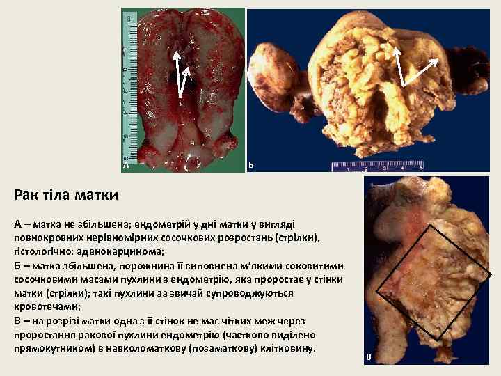 А Б Рак тіла матки А – матка не збільшена; ендометрій у дні матки