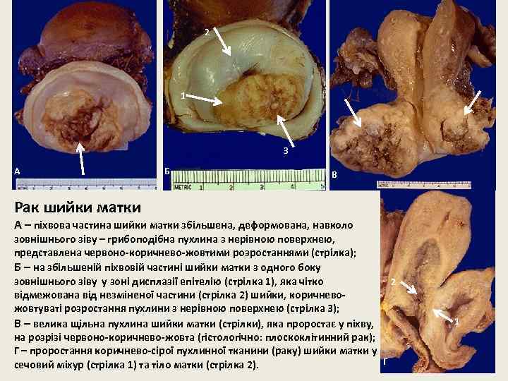 2 1 3 А Б В Рак шийки матки А – піхвова частина шийки
