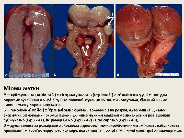 2 3 1 2 1 А Б В Міоми матки А – субмукозна (стрілка