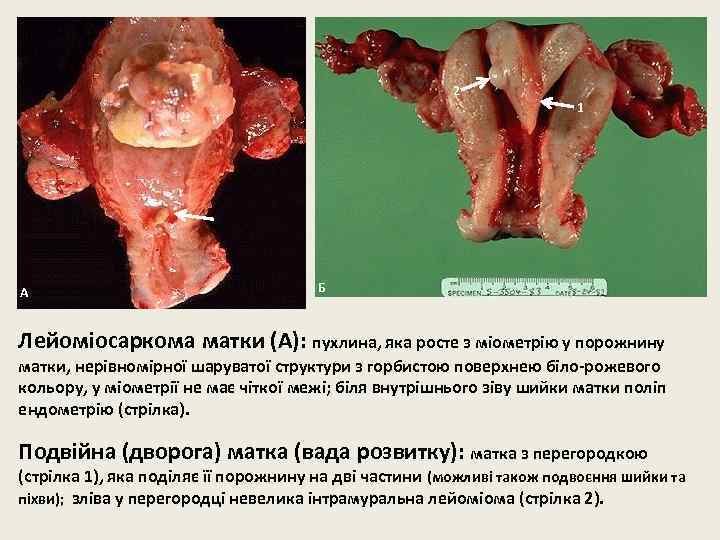 2 А 1 Б Лейоміосаркома матки (А): пухлина, яка росте з міометрію у порожнину