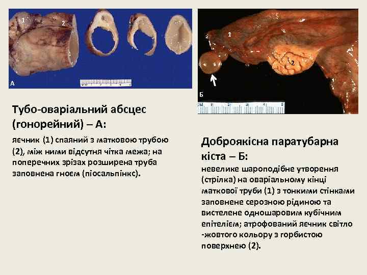 1 2 А Б Тубо-оваріальний абсцес (гонорейний) – А: яєчник (1) спаяний з матковою