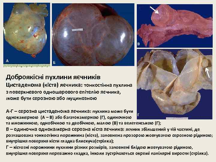 В А Б Доброякісні пухлини яєчників Цистаденома (кіста) яєчника: тонкостінна пухлина з поверхневого одношарового