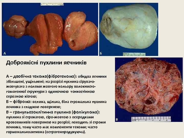 А Б Доброякісні пухлини яєчників А – двобічна текома(фібротекома): обидва яєчники збільшені, ущільнені; на