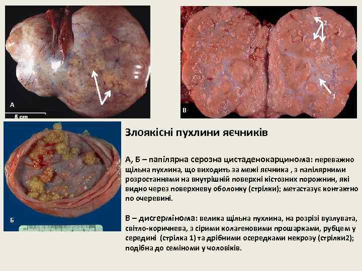 2 А 1 В Злоякісні пухлини яєчників А, Б – папілярна серозна цистаденокарцинома: переважно