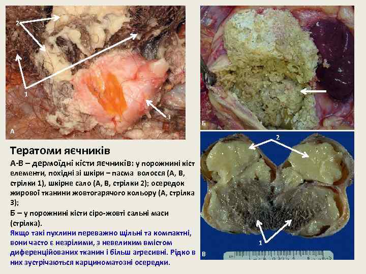 2 1 3 А Б 2 Тератоми яєчників А-В – дермоїдні кісти яєчників: у