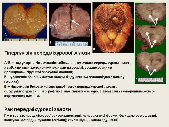 А Б Гіперплазія передміхурової залози В А-В – нодулярна гіперплазія: збільшена, вузлувата передміхурова залоза,