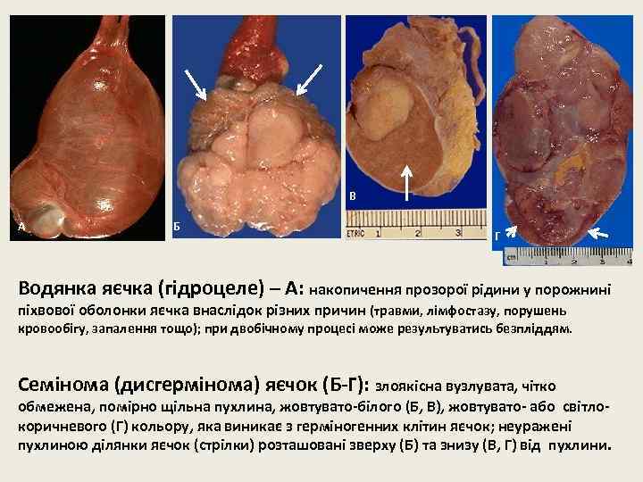 В А Б Г Водянка яєчка (гідроцеле) – А: накопичення прозорої рідини у порожнині