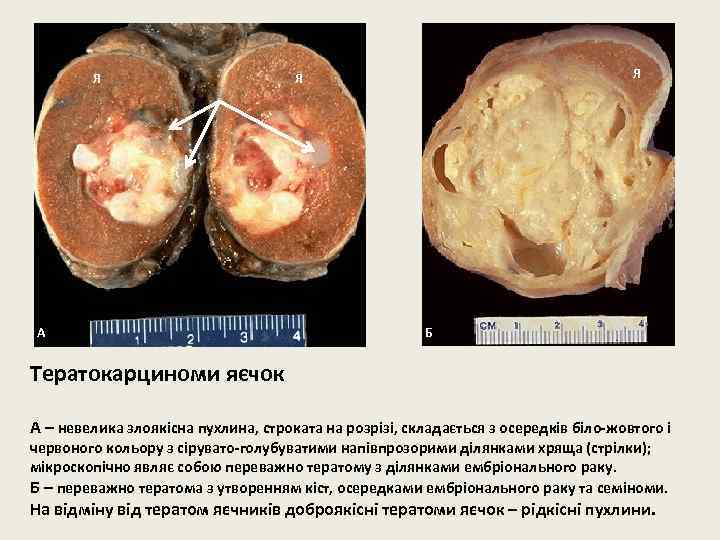 Я А Я Я Б Тератокарциноми яєчок А – невелика злоякісна пухлина, строката на