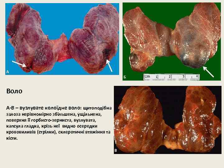 А Б Воло А-В – вузлувате колоїдне воло: щитоподібна залоза нерівномірно збільшена, ущільнена, поверхня