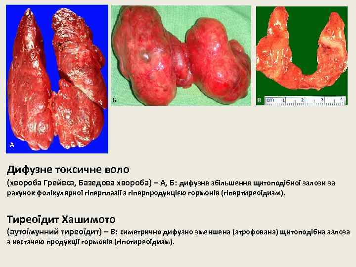 Б В А Дифузне токсичне воло (хвороба Грейвса, Базедова хвороба) – А, Б: дифузне