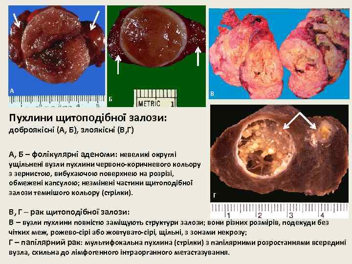 А Б В Пухлини щитоподібної залози: доброякісні (А, Б), злоякісні (В, Г) А, Б