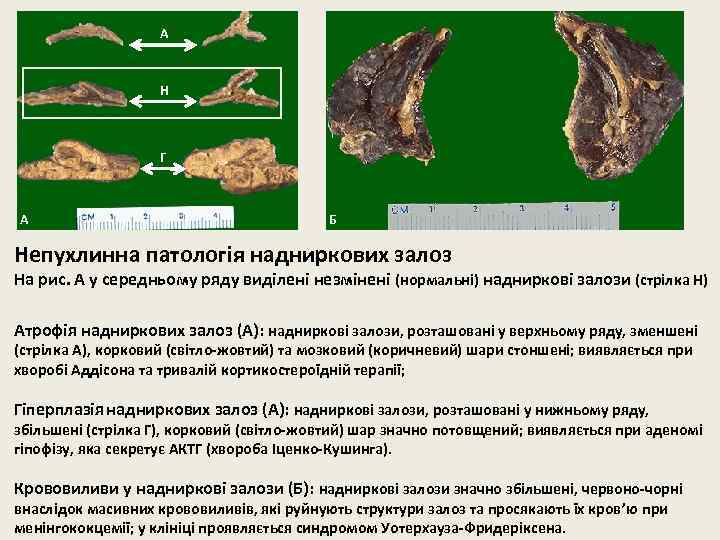 А Н Г А Б Непухлинна патологія надниркових залоз На рис. А у середньому