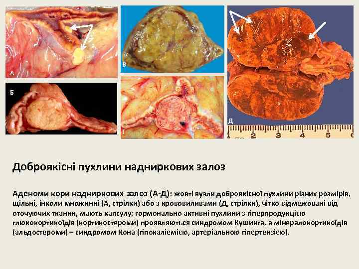 А В Б Д Г Доброякісні пухлини надниркових залоз Аденоми кори надниркових залоз (А-Д):