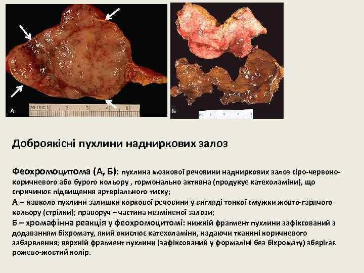 А Б Доброякісні пухлини надниркових залоз Феохромоцитома (А, Б): пухлина мозкової речовини надниркових залоз