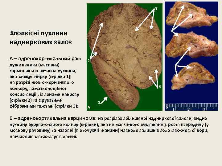 3 Злоякісні пухлини надниркових залоз А – адренокортикальний рак: дуже велика (масивна) гормонально активна