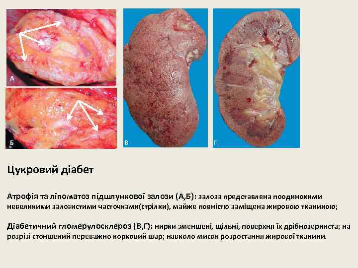 А Б В Г Цукровий діабет Атрофія та ліпоматоз підшлункової залози (А, Б): залоза