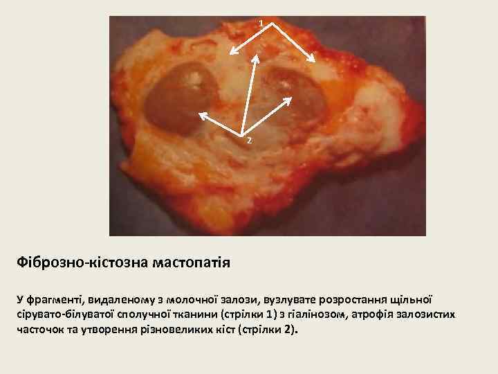1 2 Фіброзно-кістозна мастопатія У фрагменті, видаленому з молочної залози, вузлувате розростання щільної сірувато-білуватої