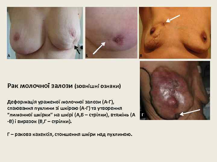 А Б В Рак молочної залози (зовнішні ознаки) Деформація ураженої молочної залози (А-Г), спаювання