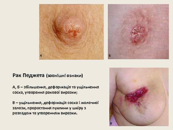 А Б Рак Педжета (зовнішні ознаки) А, Б – збільшення, деформація та ущільнення соска,