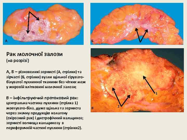 А Б Рак молочної залози (на розрізі) А, Б – різновеликі зернисті (А, стрілки)