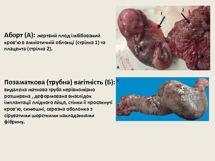 1 Аборт (А): мертвий плод імбібований кров’ю в амніотичній облонці (стрілка 1) та плацента