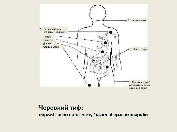 1. Надходження 3. Прояви хвороби: Гіповолемічний шок Ацидоз Блювота Діарея Спазми м язів 2.