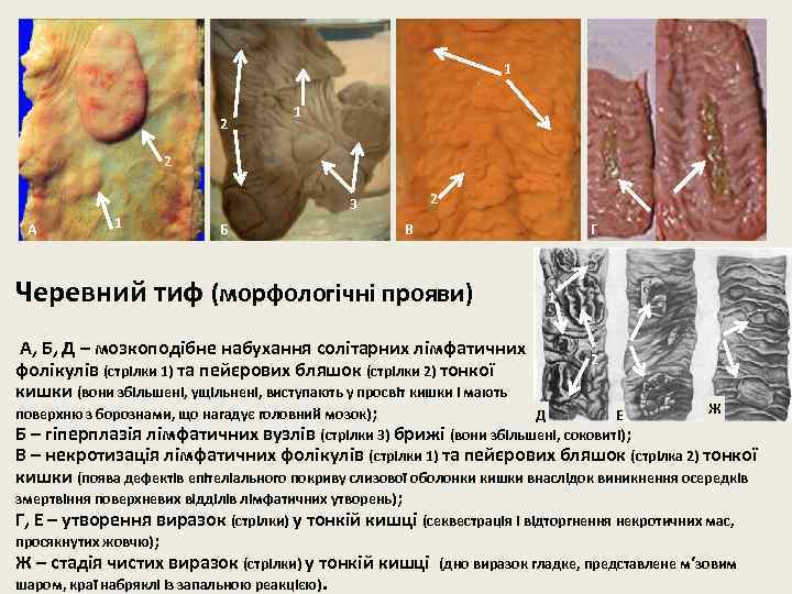 1 2 А 1 2 3 Б В Черевний тиф (морфологічні прояви) Г 1