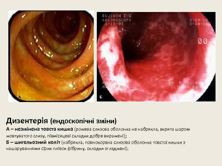 А Б Дизентерія (ендоскопічні зміни) А – незмінена товста кишка (рожева слизова оболонка не