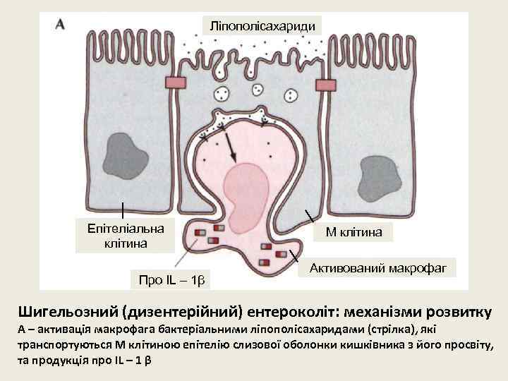 Ліпополісахариди Епітеліальна клітина Про IL – 1β М клітина Активований макрофаг Шигельозний (дизентерійний) ентероколіт: